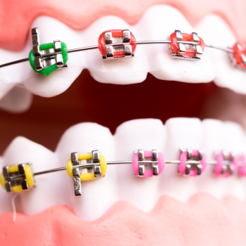 Let’s Compare Braces - Tower Dental