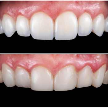 Everything You Need to Know About Veneers: Do They Damage Your Teeth?