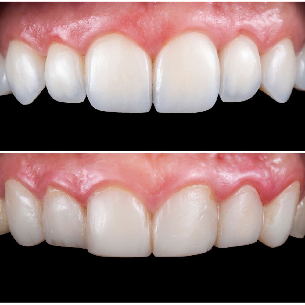 Everything You Need to Know About Veneers: Do They Damage Your Teeth?