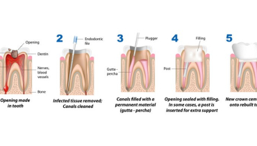 Root Canal Treatment