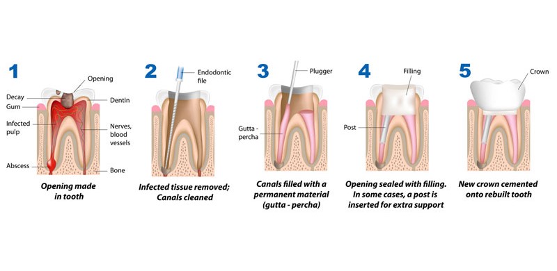 Root Canal Treatment