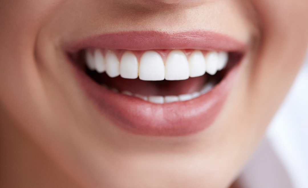 Teeth Whitening Treatment