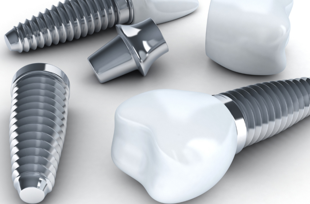 Banish Uncomfortable Bridges And Unsightly Gaps With Tooth Implants