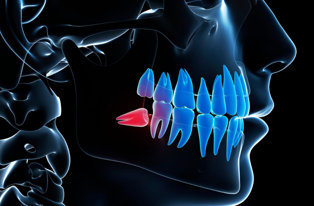Wisdom Teeth Removal