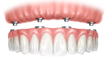 Denture Supported by Implants