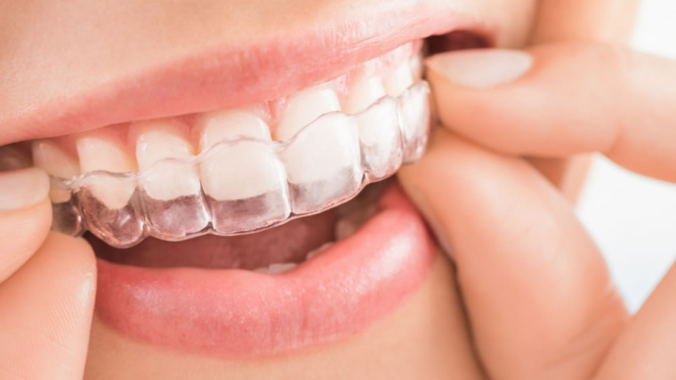 What Happens if You Forget to Wear Your Invisalign Aligners?
