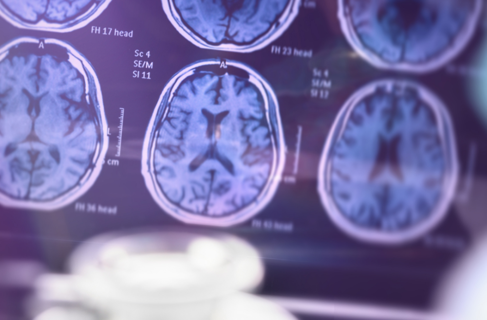 Can Gum Disease Cause Alzheimer’s And Other Health Problems?