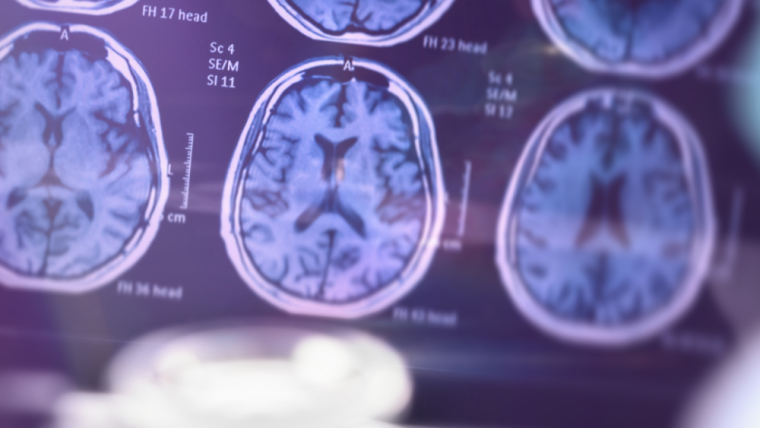 Can Gum Disease Cause Alzheimer’s And Other Health Problems?