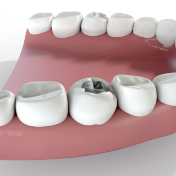 Are You Concerned About Traditional Dental Fillings?
