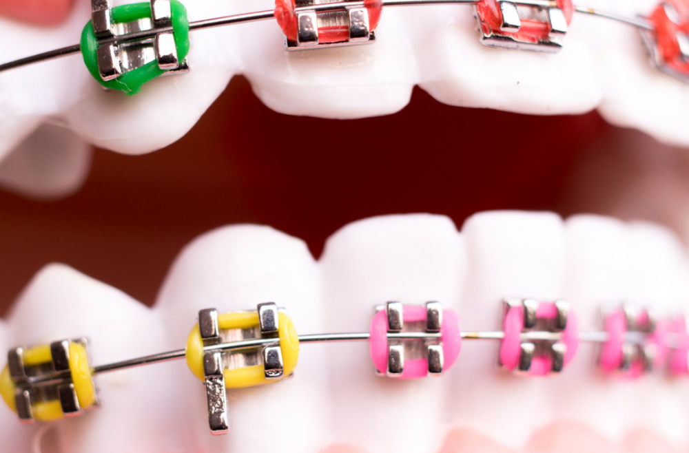 Let’s Compare Braces