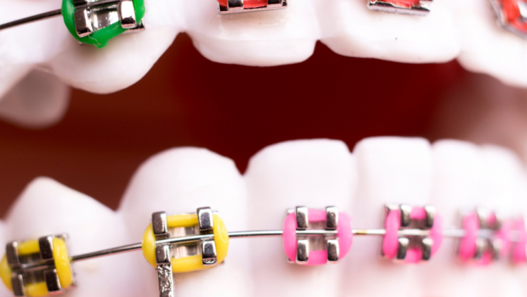 Let’s Compare Braces