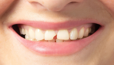 Fixing Broken and Chipped Teeth