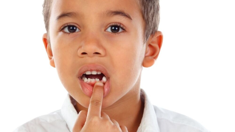 What To Do If Your Child Chips A Tooth