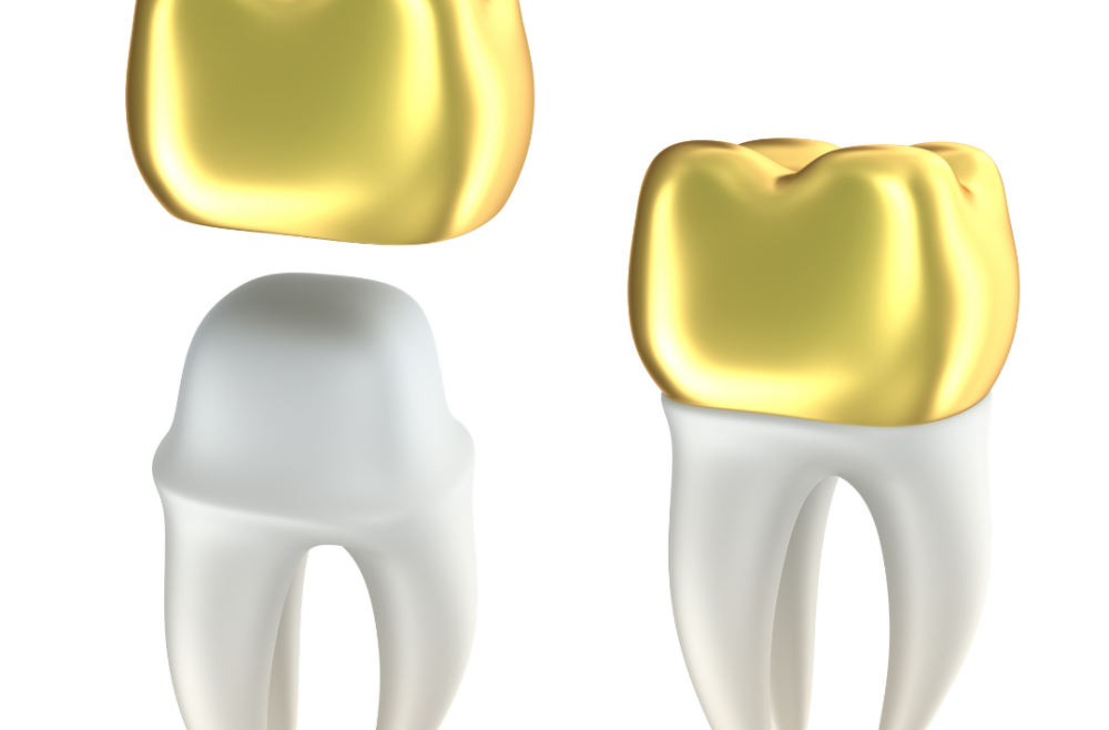 The Benefits Of Dental Crowns & Dental Bridges