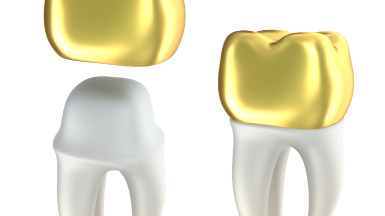 The Benefits Of Dental Crowns & Dental Bridges