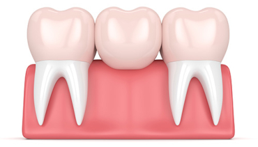 Dental Bridge Box Hill