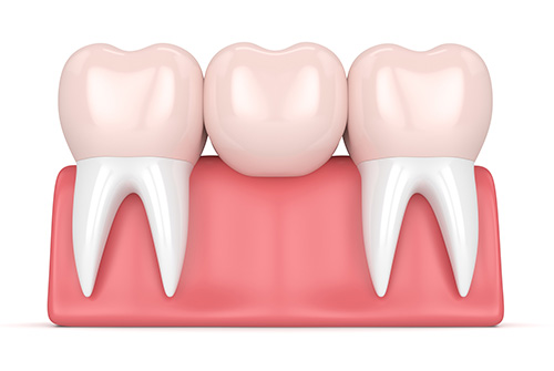 Dental Bridge