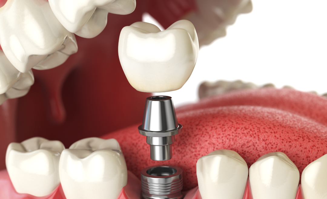 Dental Crowns