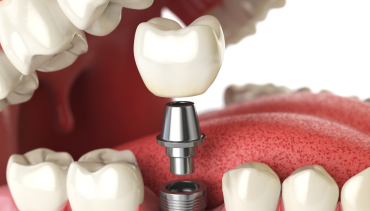 Dental Crowns