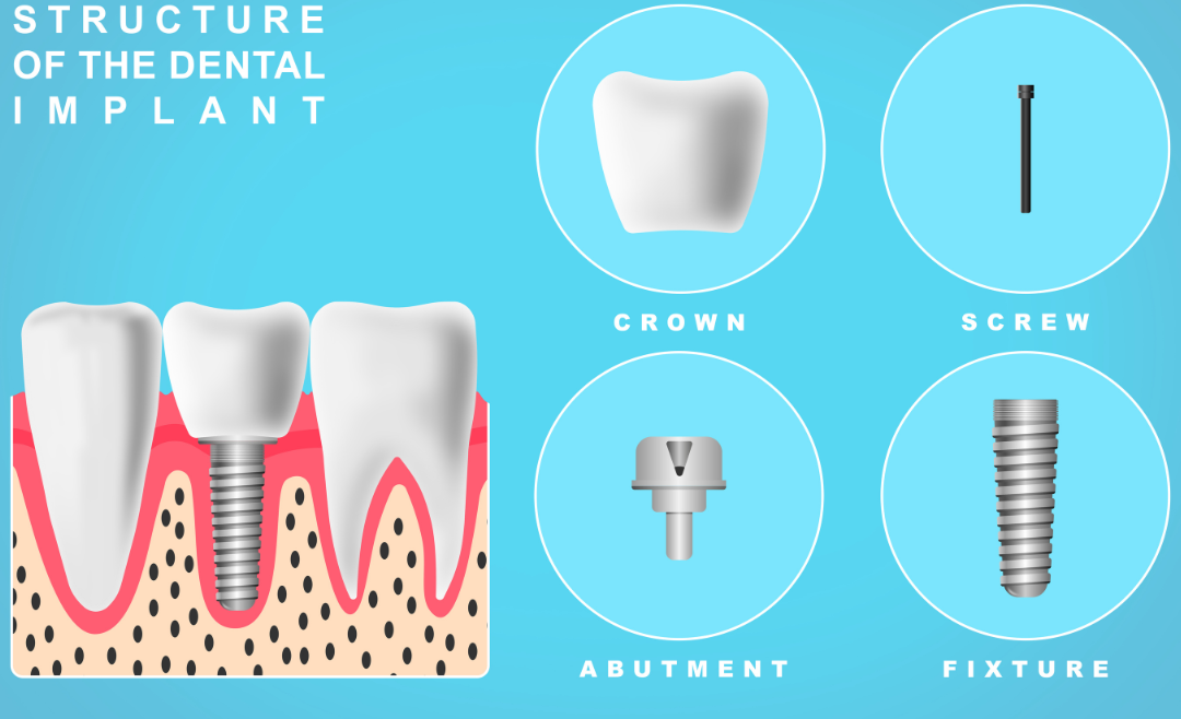Dental Implants