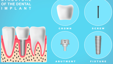 Dental Implants Canterbury