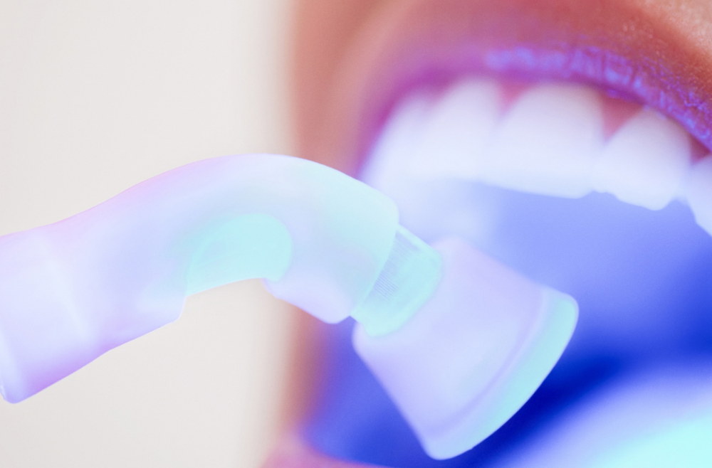 Dental Fillings