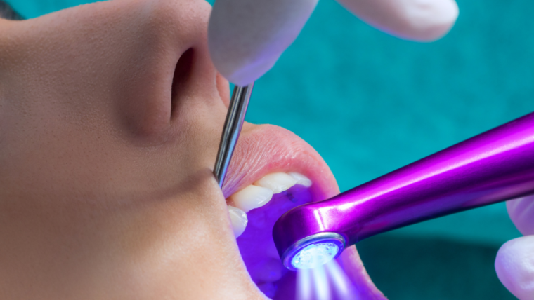 Have you got questions about dental fissure sealant?