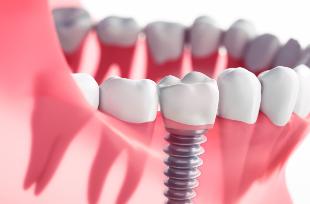 Are Dental Implants Worth The Money?