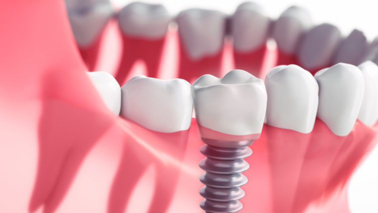 Are Dental Implants Worth The Money?