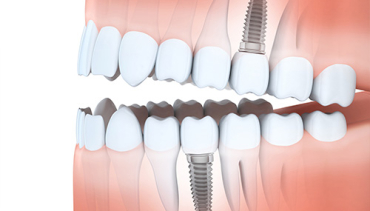 Multiple Tooth Implants canterbury