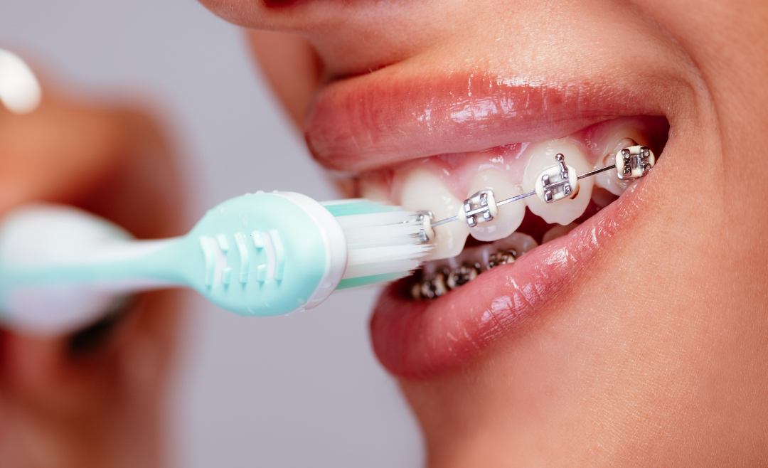 Orthodontics for Adults