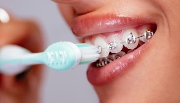 Orthodontics for Adults