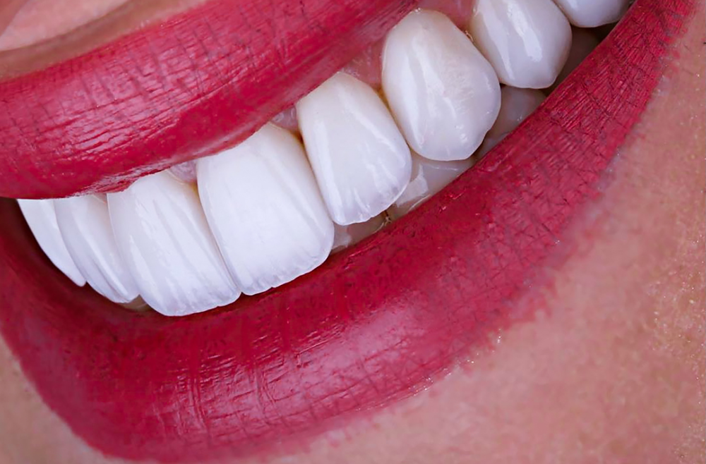 Transform Your Smile With Veneers