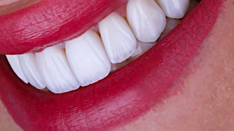 Transform Your Smile With Veneers