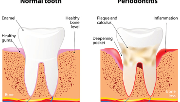 Gums and Periodontal Problems
