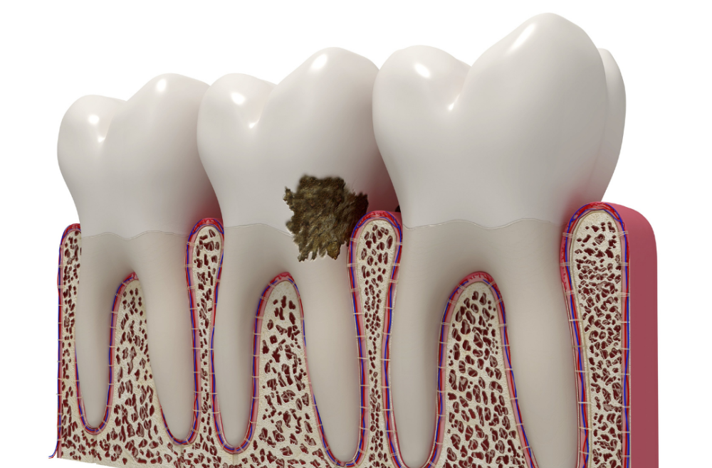 Suffering from Periodontal disease?