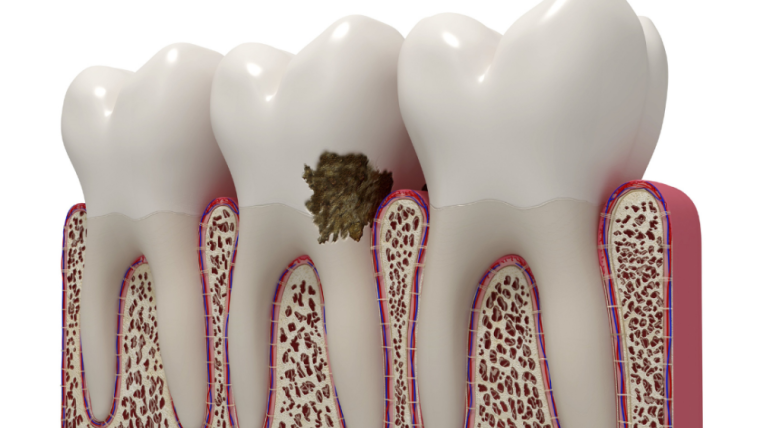 Suffering from Periodontal disease?