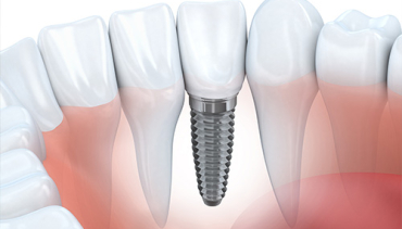 Single Tooth Implants Canterbury