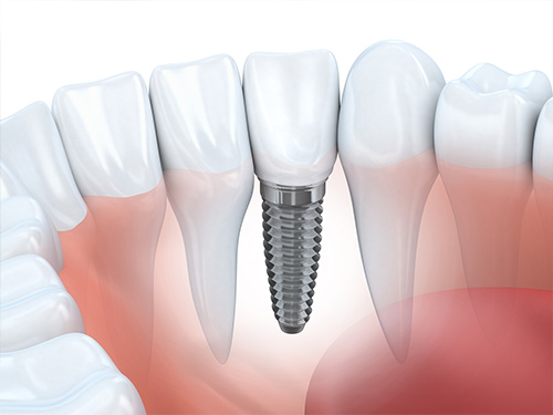 Single Tooth Implants