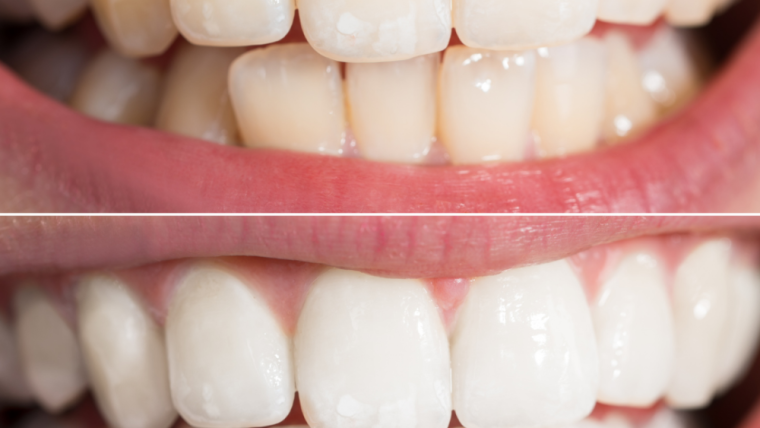 6 Ways Teeth Whitening Can Change Your Life