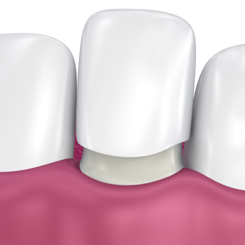 Are You A Good Candidate for Veneers?