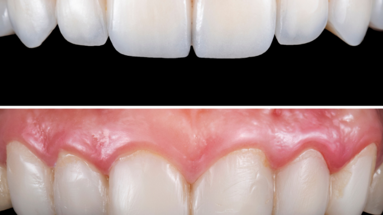 Everything You Need to Know About Veneers: Do They Damage Your Teeth?