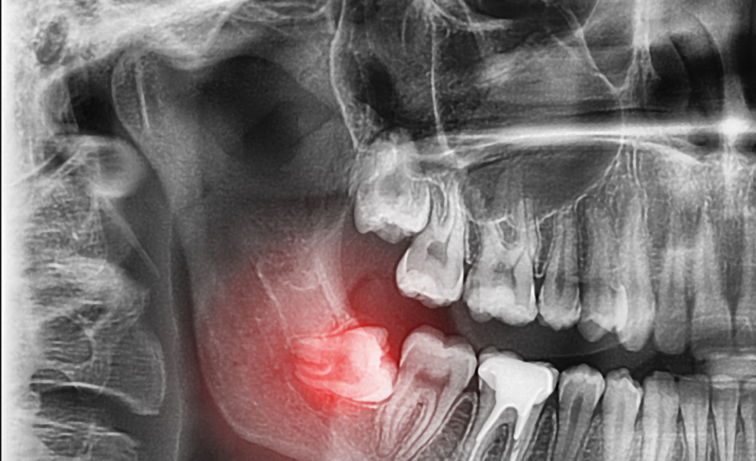 Wisdom Teeth