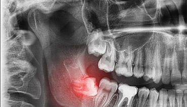 Wisdom Teeth
