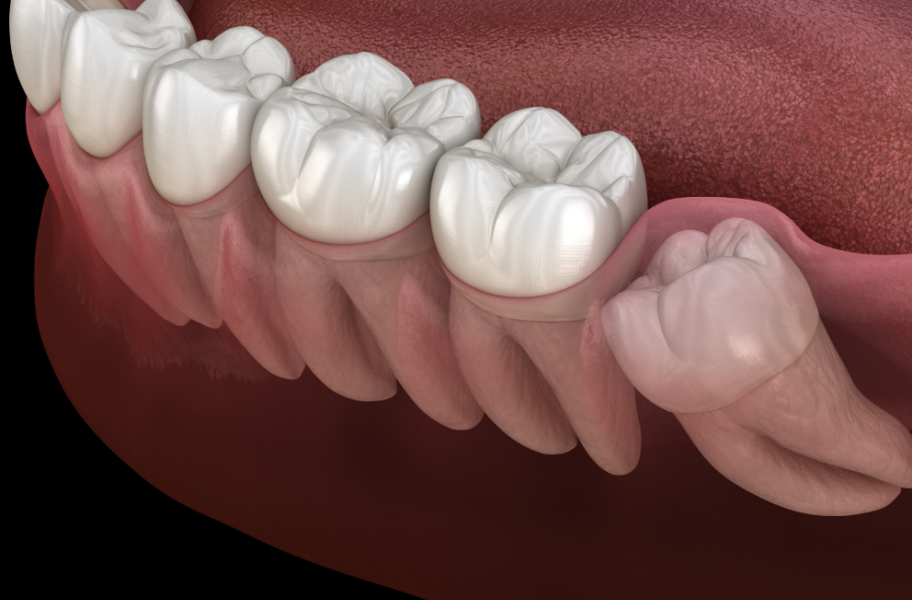 Signs You Need Your Wisdom Teeth Taken Out