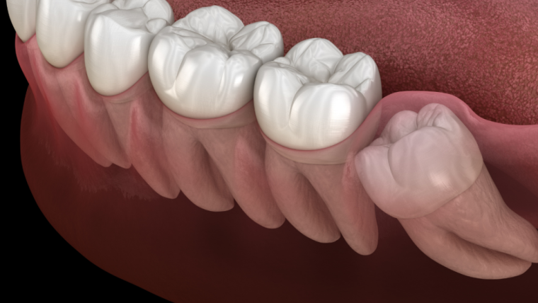 Signs You Need Your Wisdom Teeth Taken Out