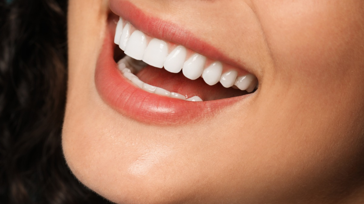 Veneers Canterbury
